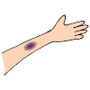 Bruise  Picture
