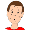 Acne  Picture