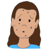 Acne  Picture
