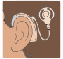 Cochlear Implant Picture