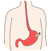 G-Tube  Picture