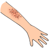 Rash