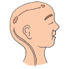 Brain Shunt  Picture