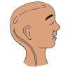 Brain Shunt  Picture
