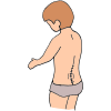 Spina Bifida  Picture