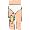 Catheter  Picture