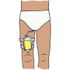 Catheter  Picture