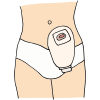Colostomy Pouch  Picture