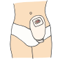 Colostomy Pouch Picture